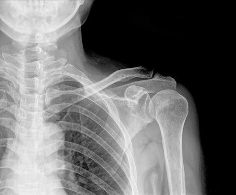 Densitometria ossea con ultrasuoni