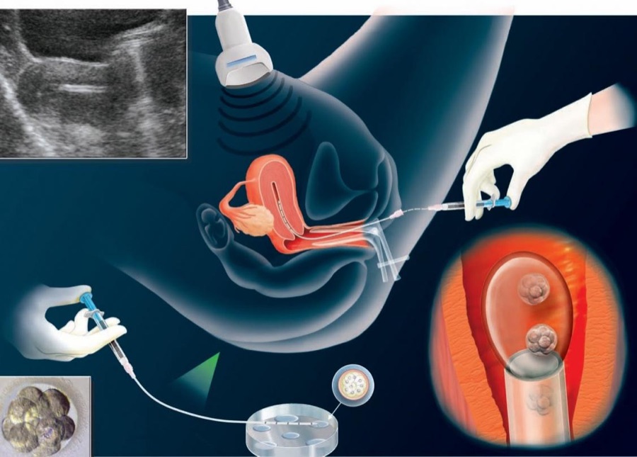 FIV — Fecondazione in vitro