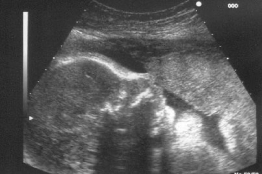 Flussimetria materno-fetale